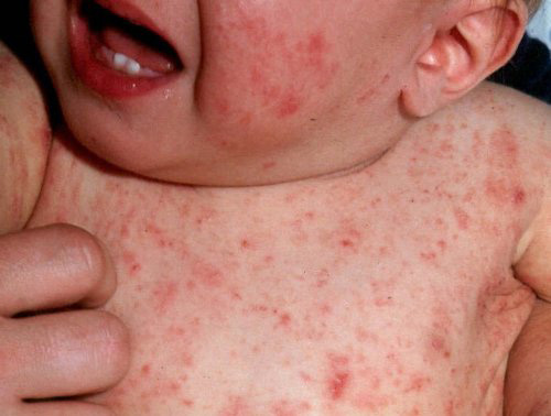 Child scabies