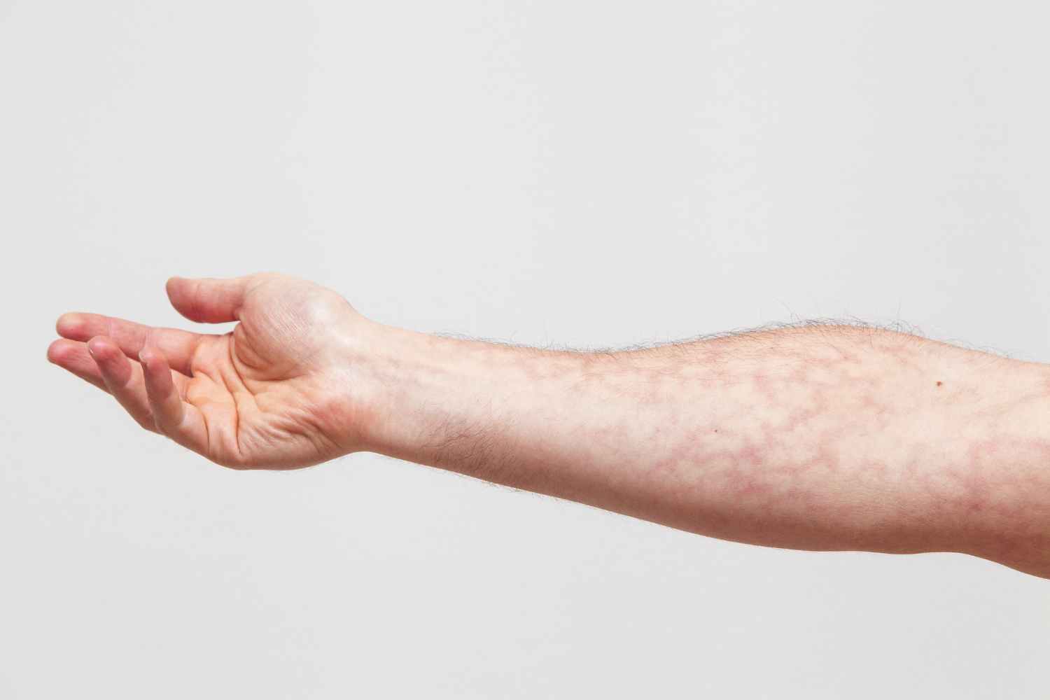 forearm acupressure
