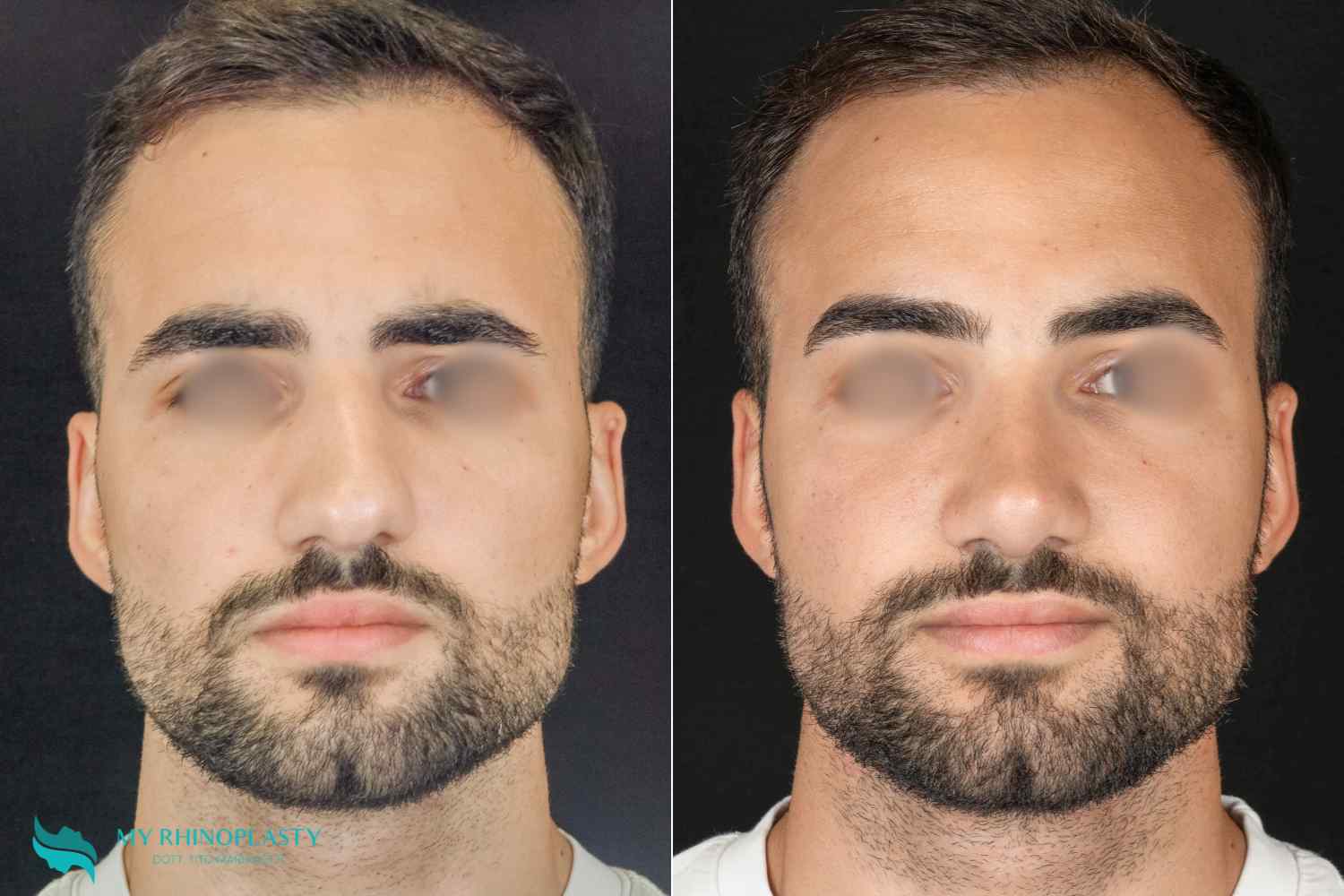 deviated nasal septum 