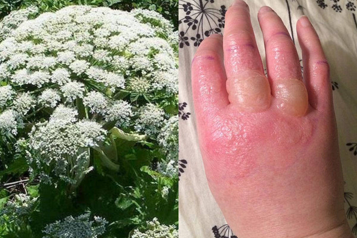 Montegazza hogweed burns