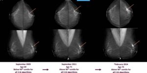 Breast cancer, AI can intercept cancer signals 3 to 6 years before diagnosis