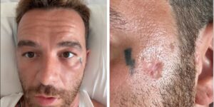 “I put on sunscreen and the result is skin cancer”: Salmo’s story reignites the controversy over sunscreens, but science says otherwise