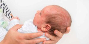 Rash in children? The glass test every parent should know