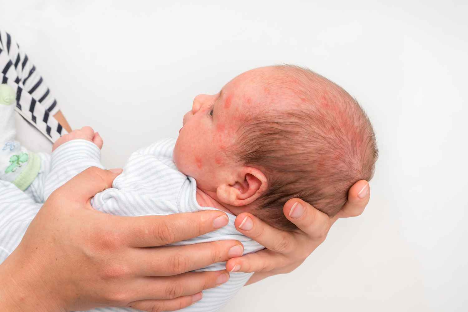 Rash in children? The glass test every parent should know