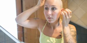 Alopecia: This common arthritis drug is causing 1,400 patients to regrow much of their hair
