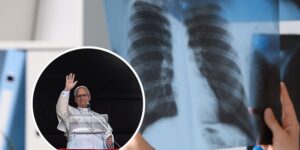 Does a nodule in the lung (like Pope Leo’s) mean cancer? From diagnosis to surgery, what you need to know