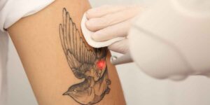 Removing a tattoo is not that simple: costs, times and risks to know according to experts